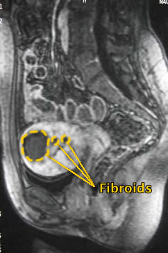 After Emboshperes have blocked blood flow to the fibroids, the fibroids shrink over the course of a year