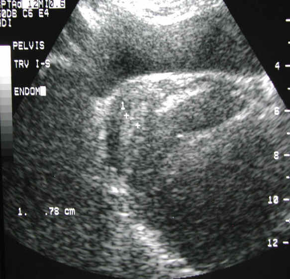 on ultrasound was found to have a prominent posterior fibroid