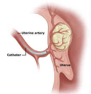 Diagram of catheter inserted into uterine artery
