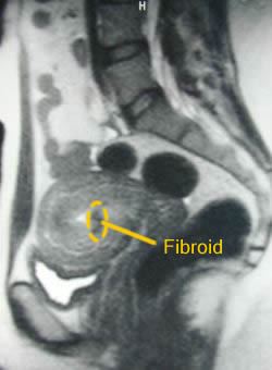 MRI showing same area 12 months after treatment