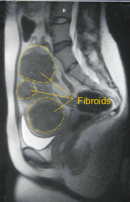 MRI showing fibroids