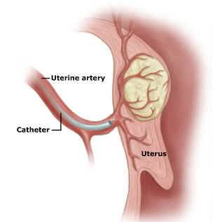 Diagram showing catheter insertion