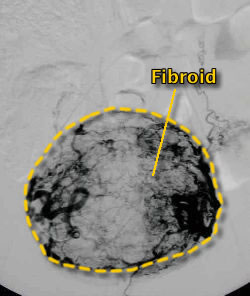 Angiogram before procedure