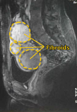 before embospheres