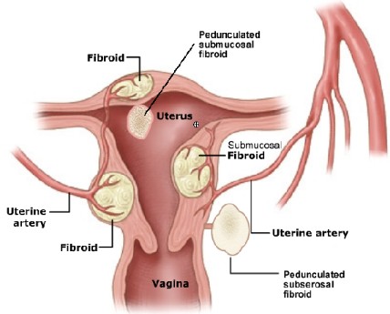 Drawing showing different types of uterine fibroids